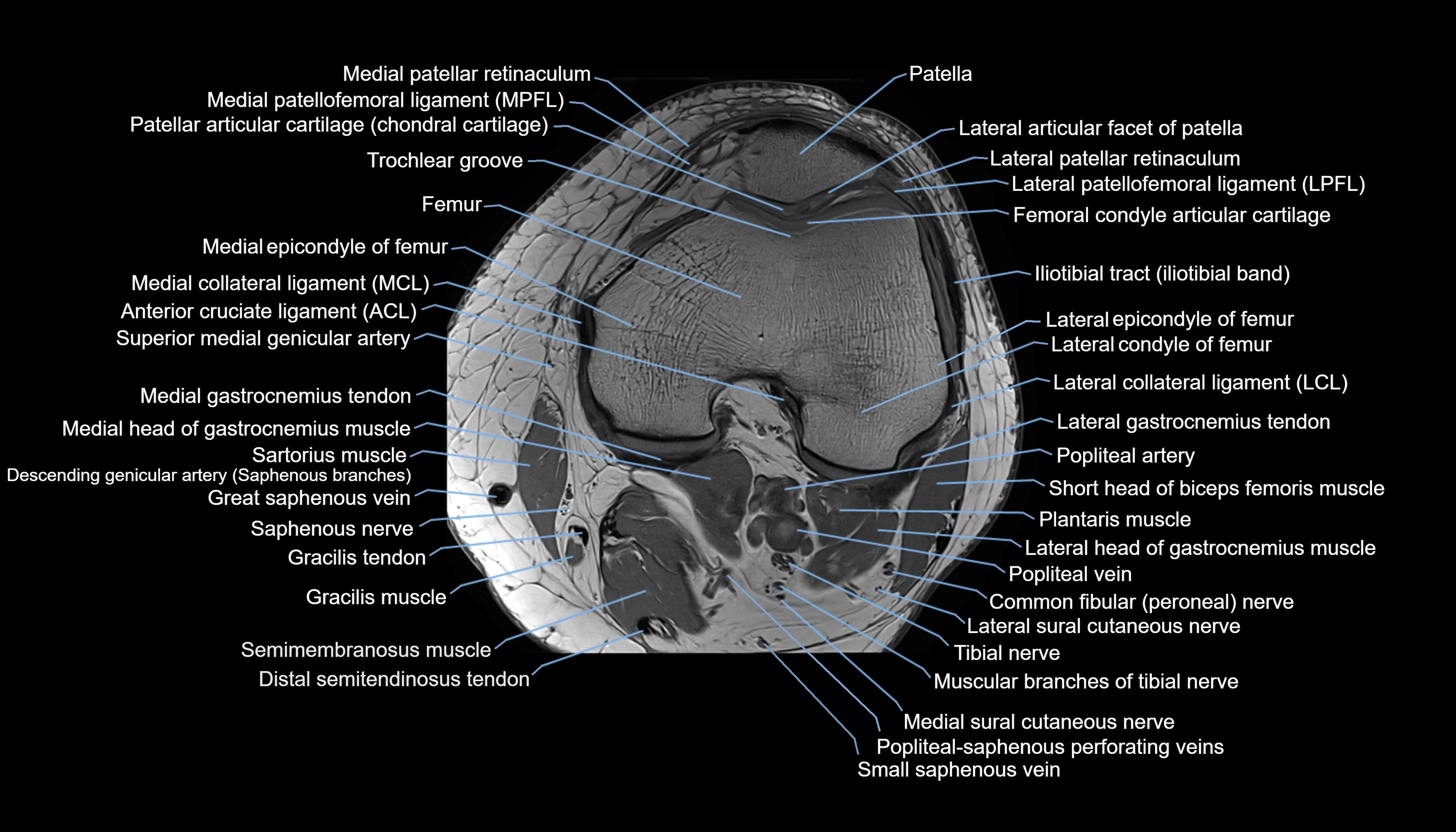 MRI knee  axial cross sectional anatomy 3T radiology  image-img-00001-00019.webp